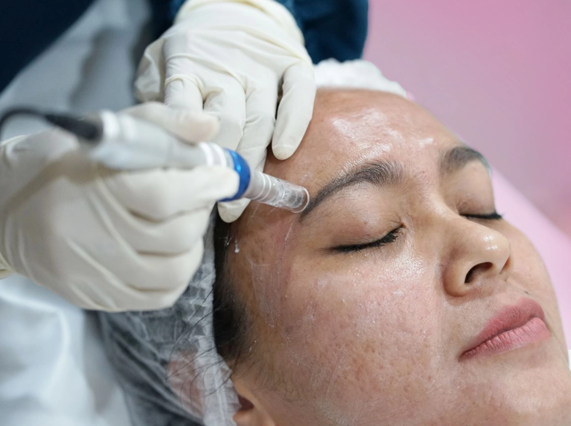 Pasien sedang menjalani acne treatment di klinik kecantikan kontura