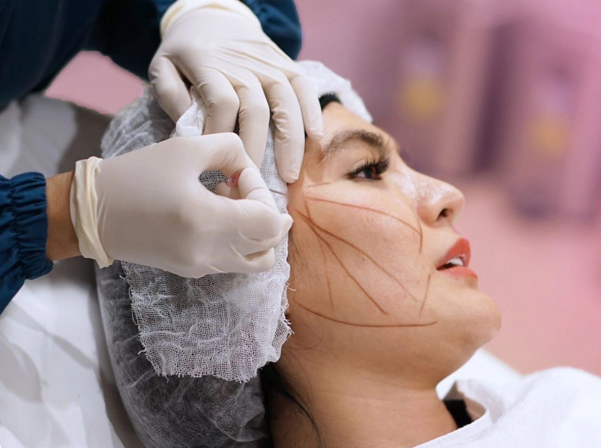 Pasien Kontura sedang menjalani treatment Threadlifting