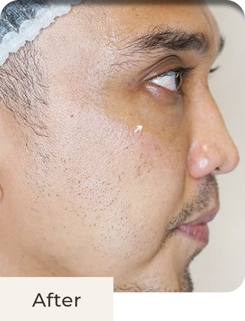 Foto pasien after treatment Hyperpigmentation Solution - Filler