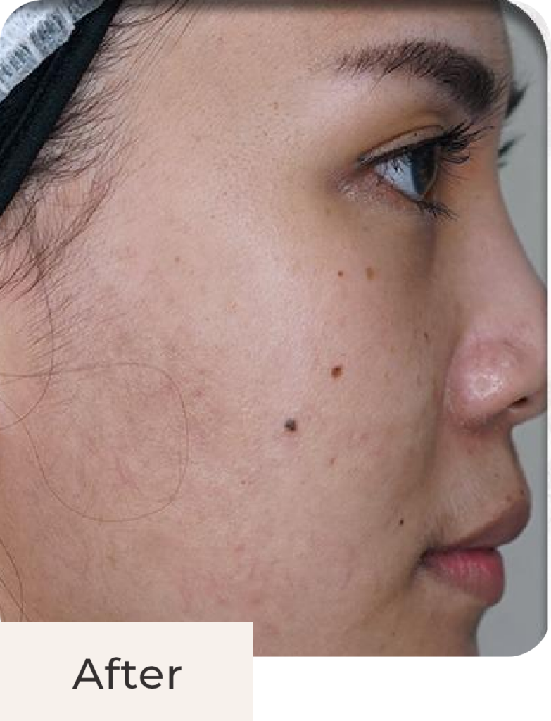 Foto tampak samping after acne treatment di Kontura