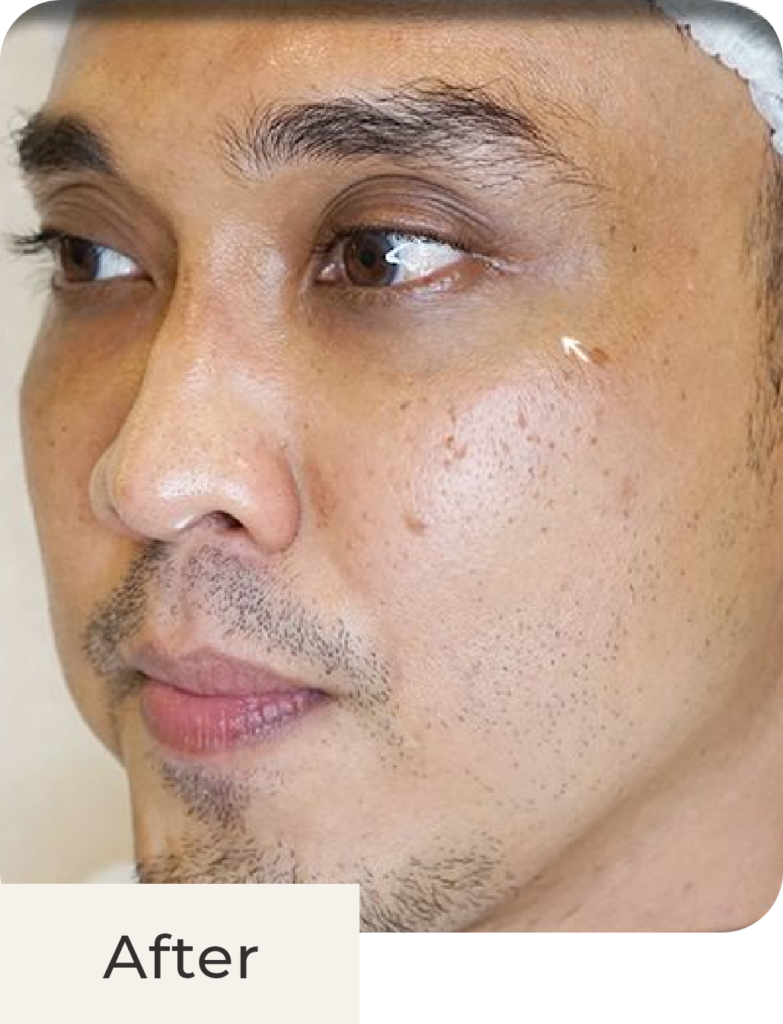 Foto pasien tampak samping after treatment Hyperpigmentation Solution - Glass Skin