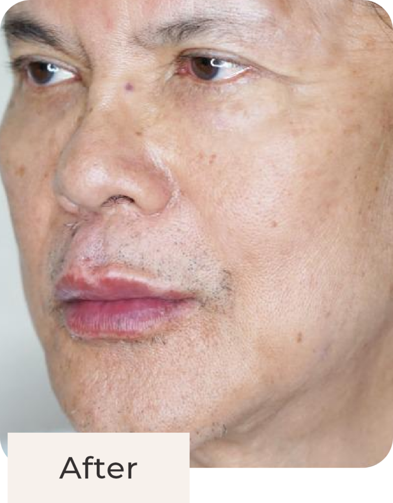 Foto pasien after treatment anti wrinkle injection di Kontura
