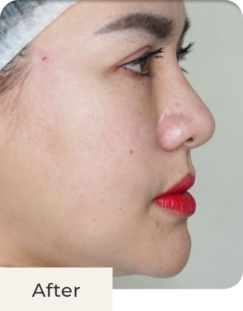 Tampak samping after treatment Threadlift Face & Double Chin