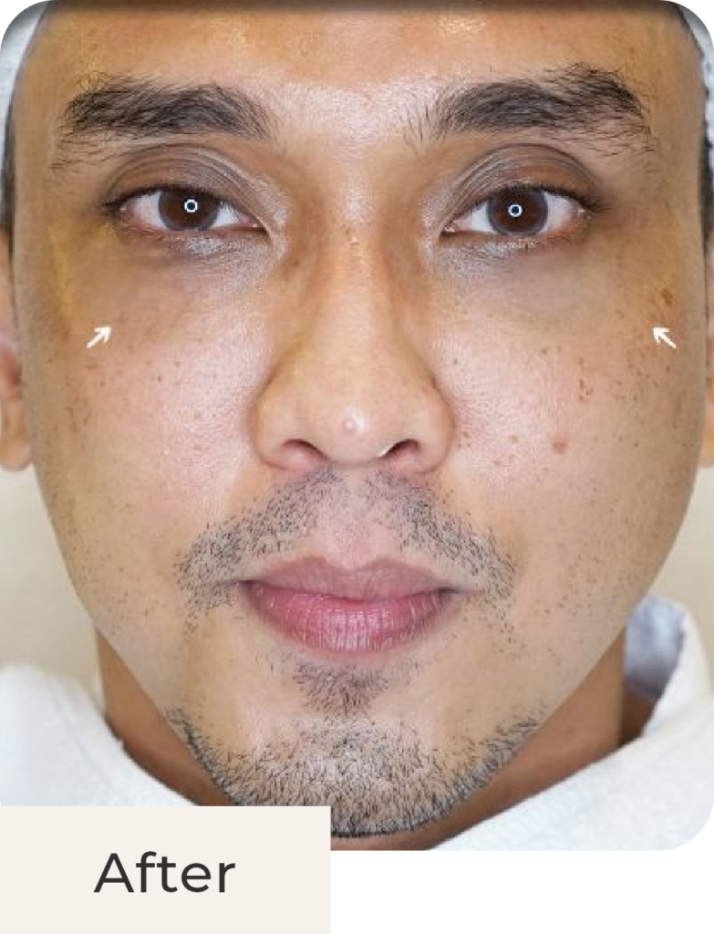 Foto pasien after treatment Hyperpigmentation Solution - Glass Skin