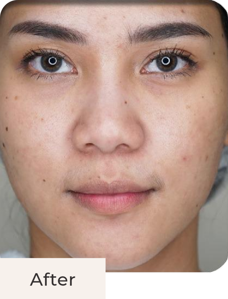 Foto tampak depan after acne treatment di Kontura