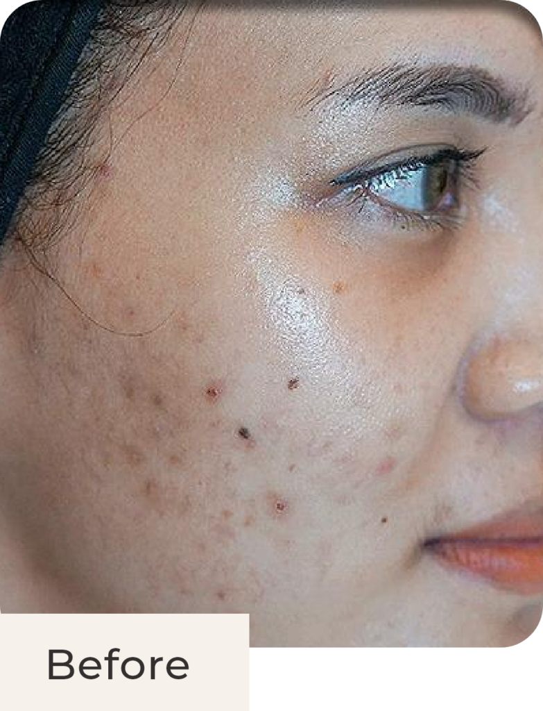 Foto tampak samping before acne treatment di Kontura