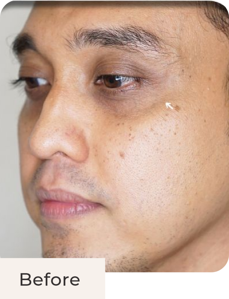Foto pasien tampak samping before treatment Hyperpigmentation Solution - Glass Skin