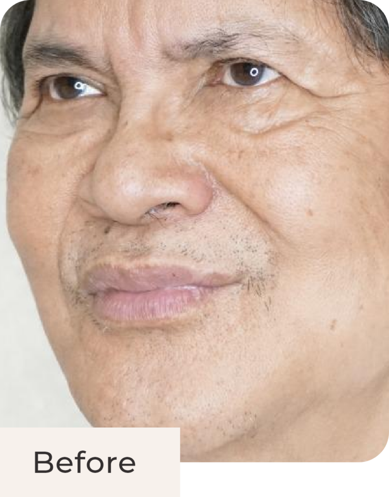 Foto pasien before treatment anti wrinkle injection di Kontura