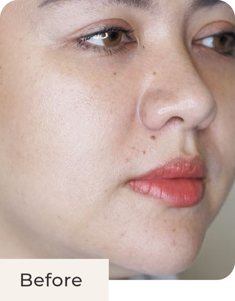 Wajah Vicky Shu before treatment Threadlift Face & Double Chin