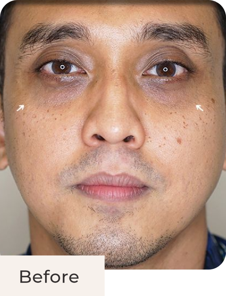 Foto pasien before treatment Hyperpigmentation Solution - Glass Skin