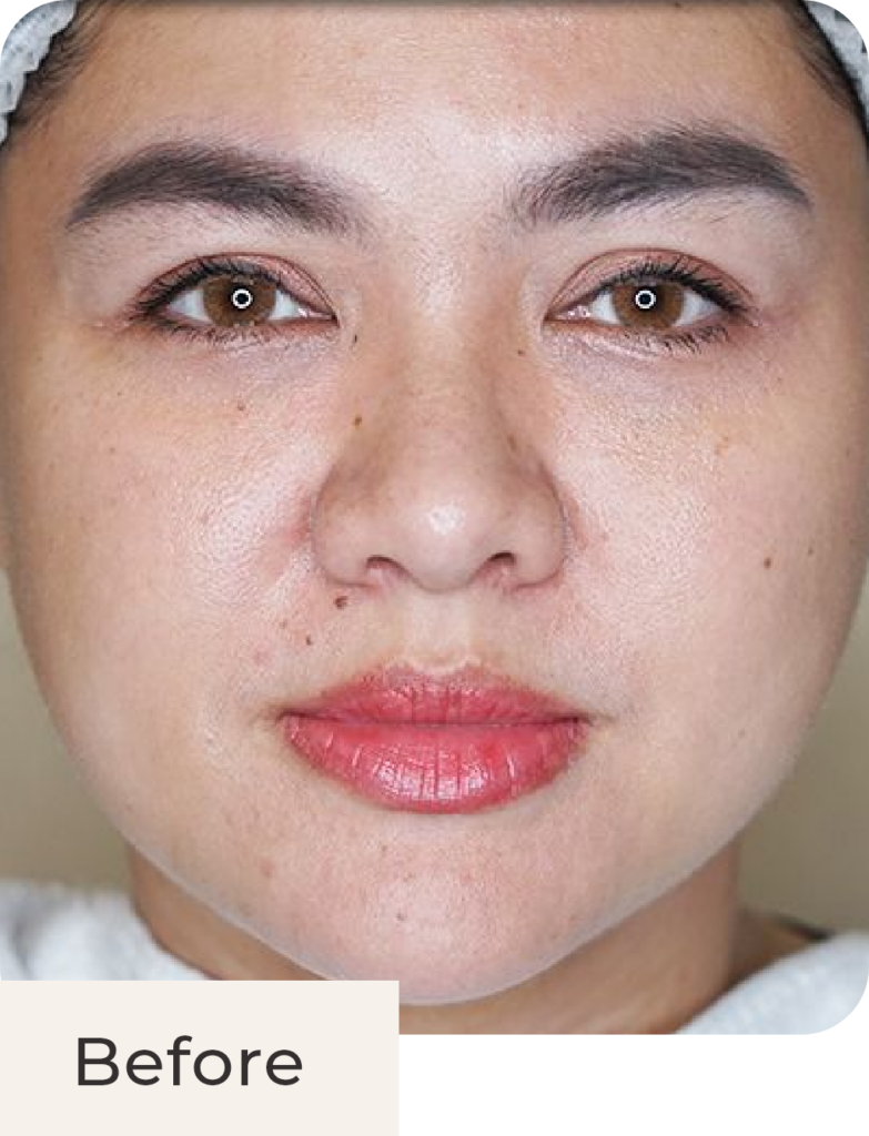 Tampak depan before treatment Threadlift Face & Double Chin