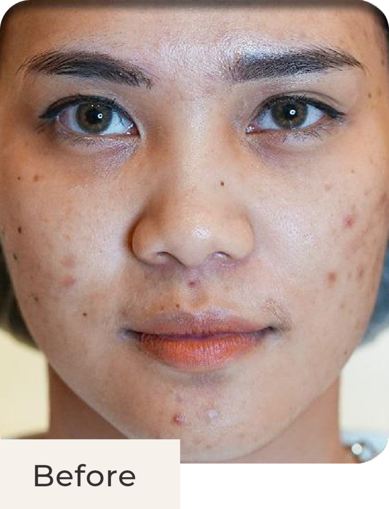 Foto tampak depan before acne treatment di Kontura