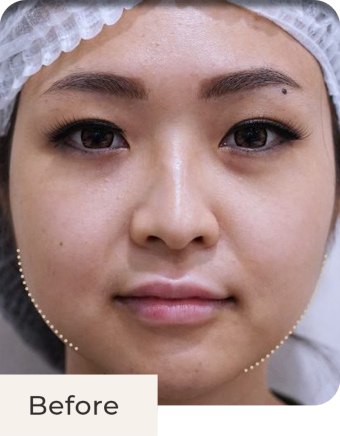 Foto pasien before treatment Evo-Tox Face di Kontura